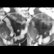 Crohn's disease, aboral ileum, enteroclysis: RF - Fluoroscopy